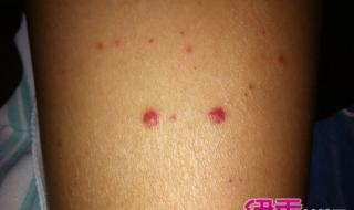 白血病初期小红点图片 白血病初期小红点图片